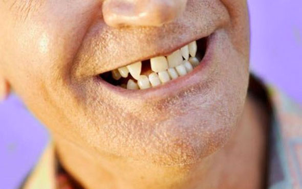  Diş eksikliği duygusal travmaya neden oluyor 