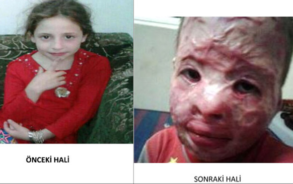 Suriyeli kız çocuğu böyleydi bu hale geldi