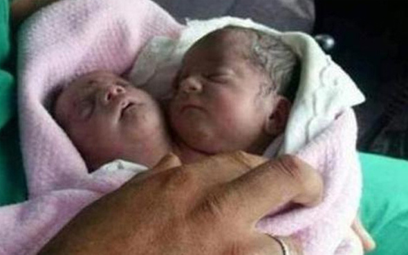 Suriye'de iki kafalı bebek dünyaya geldi
