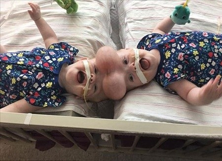 Yapışık ikizlerin ameliyatla ayrıldı 