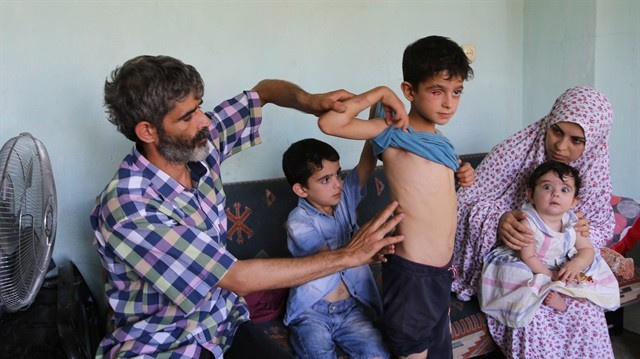 Suriyeli baba-oğul 'protez göz' için çöp topluyor 