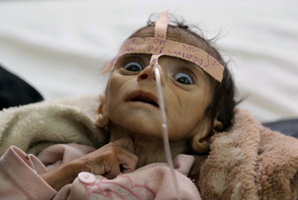 85 bin bebek açlıktan hayatını kaybetti Yemen kan ağlıyor