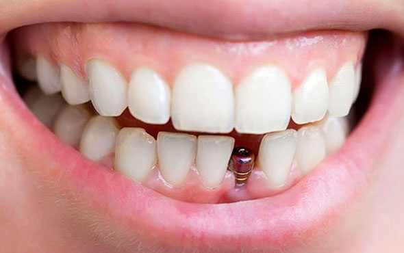 Diş hekimi Engin Taviloğlu: "Diş fırçalamak yerine implant yaptırıyorlar!"