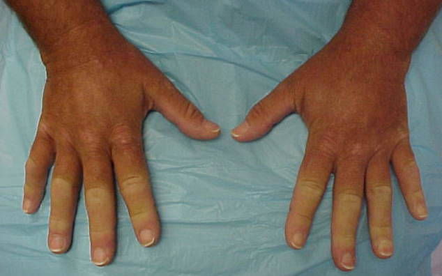 İnsanların el ve parmakları neden soğur? Tehlikeli olabilir