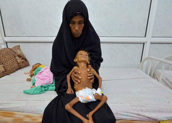 Yemen açlıktan ölüyor çocuklar bir deri bir kemik son duruma bakın