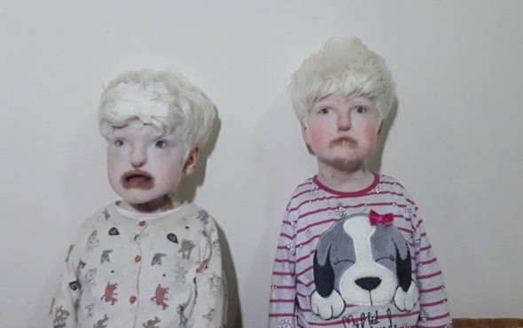 Albino kardeşler yardım bekliyor! 
