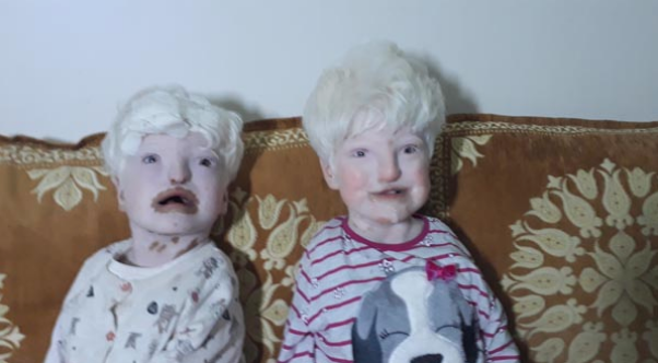 Albino kardeşler yardım bekliyor! 