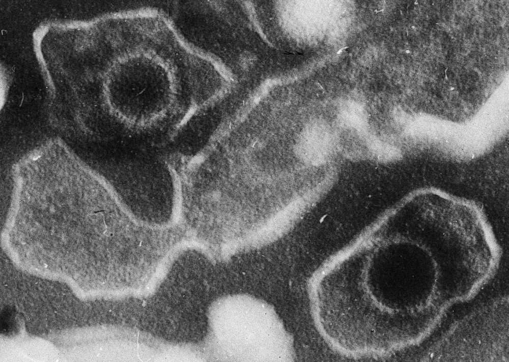 'Öpücük virüsü' 7 çeşit hastalığa neden oluyor