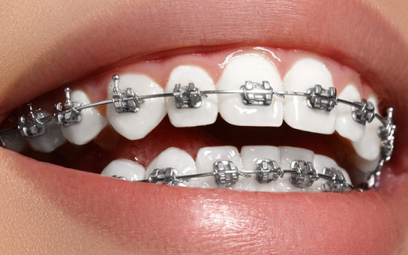 Diş teli kullananlar için ağız bakım önerileri...