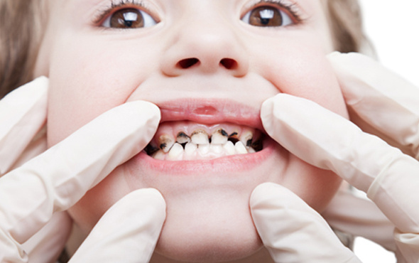 Çocuklarda diş çürüğünün sebebi nedir?