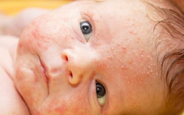 Çocukları sonbaharda alerjiden korumanın 12 basit yöntemi
