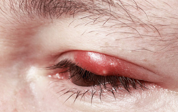 Göz kapağı enfeksiyonu nedir, bitkisel çözüm yolları nelerdir?