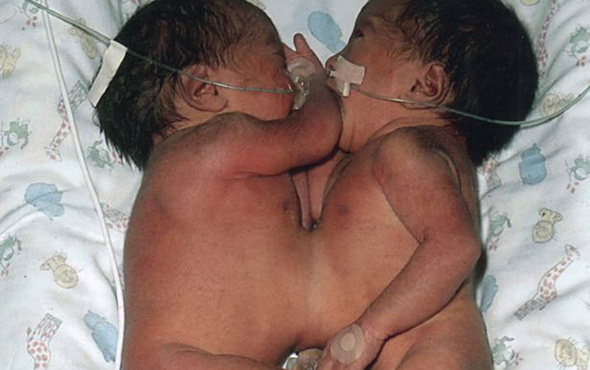 Doktorların yaşamaz dediği mucize ikizler 16 yaşına girdi