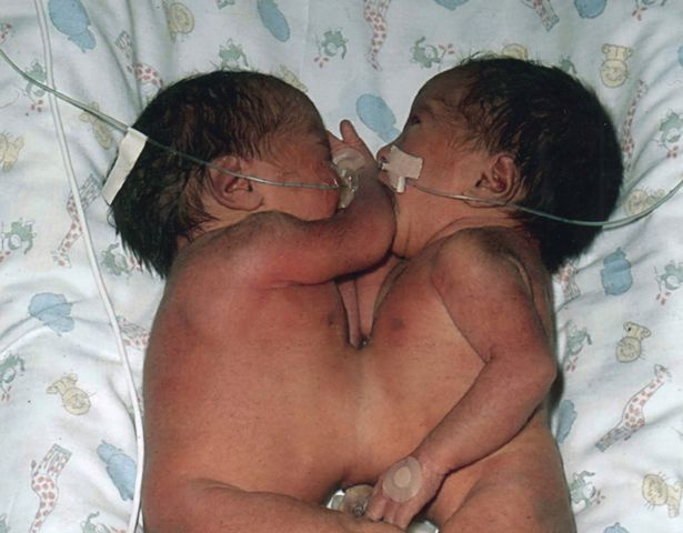 Doktorların yaşamaz dediği mucize ikizler 16 yaşına girdi