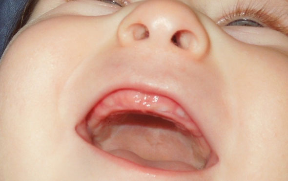 Diş çıkaran bebeklere ne iyi gelir?