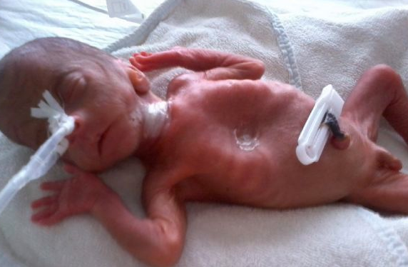 600 gram doğan bebek mucize yarattı