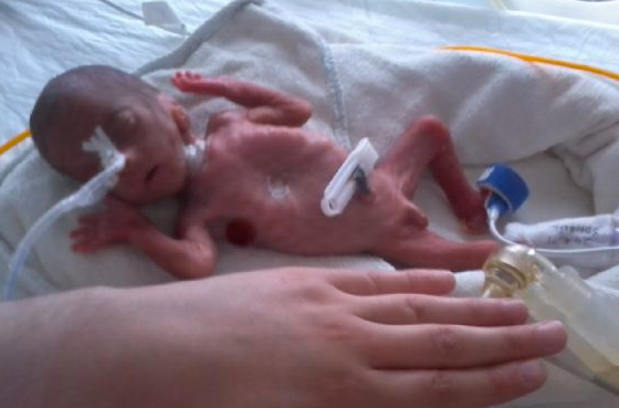 600 gram doğan bebek mucize yarattı