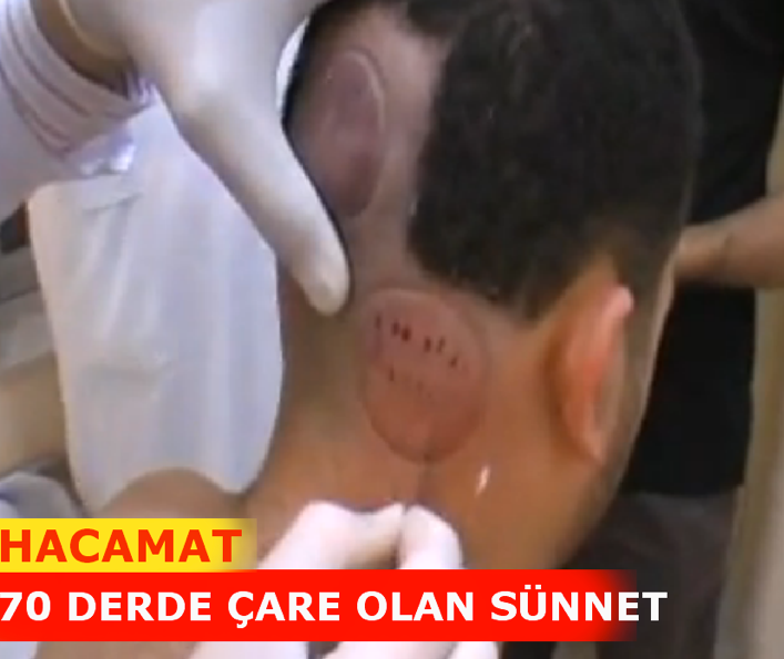 Peygamber sünneti olan hacamat nedir?