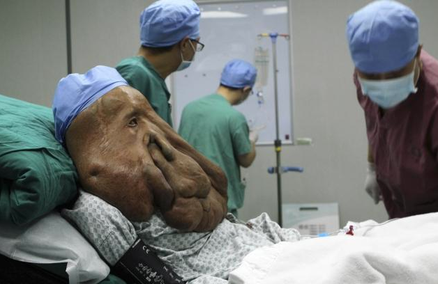 En büyük yüz tümörü ameliyatı