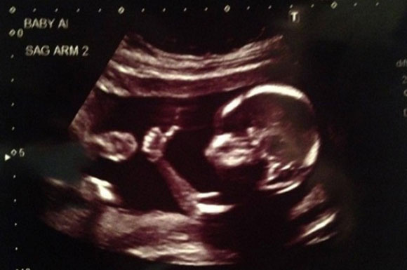 Ultrasonda bebek görüntüsü yerine çıkan şeyler