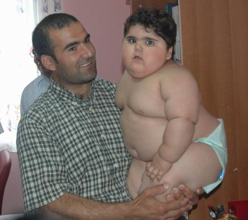 2 yaşındaki Sümeyye tam 33 kilo