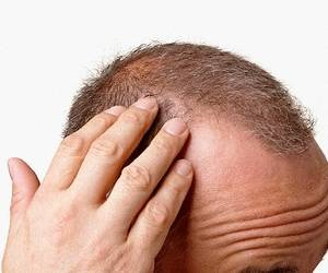 Saç dökülmesi nedenleri ve tedavisi