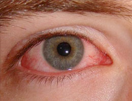 Kırmızı göz hastalığına dikkat!