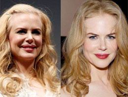 Nicole Kidman'ın botoks pişmanlığı