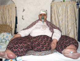 Mardinli fil hastası kadının dramı