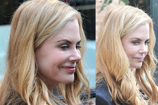 nicole-kidman-botoks.jpg