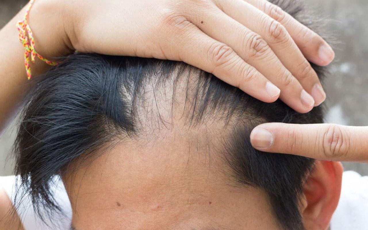 Saç dökülmesi neden olur bazı ilaçlar kel bırakıyor saç kıran da kötü