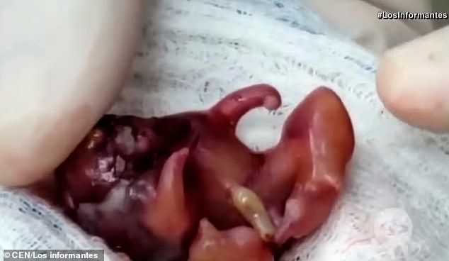Kolombiya’da ilginç doğum bebek içinde bebek