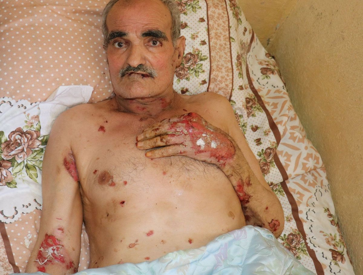 Vücudunu ve ağzının içini saran yaralar kabusu oldu! Suriyeli adamın yürek yakan feryadı