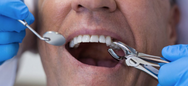 Diş çekiminin ardından dikkat edilmesi gerekenler Sağlık Haberleri