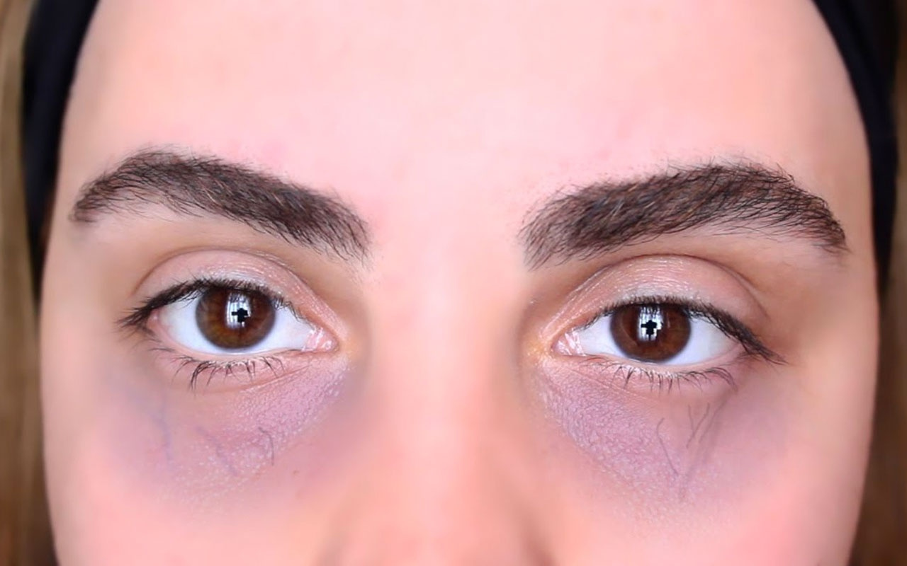 Göz altı morlukları nasıl geçer işte tek seanslık tedavisi