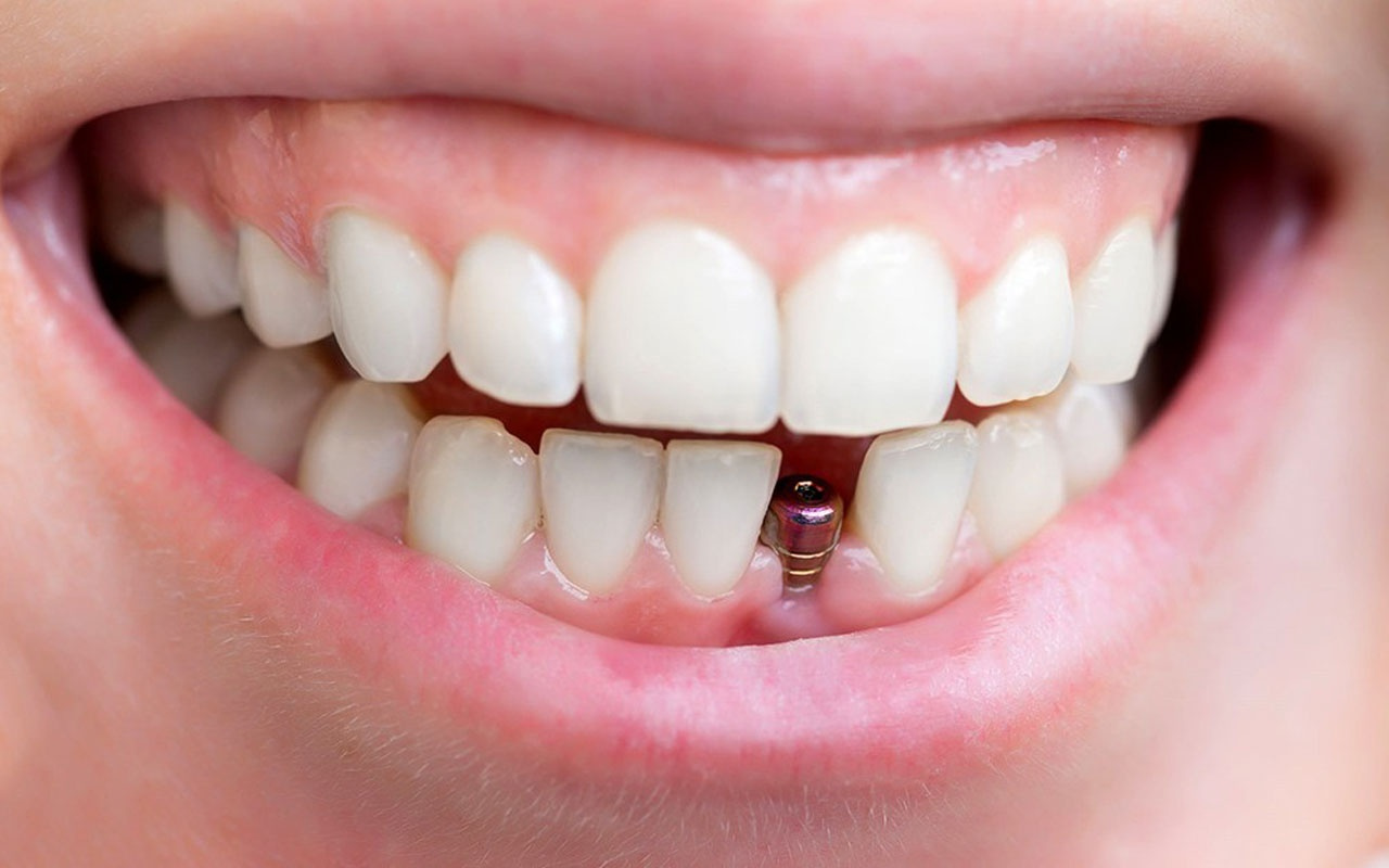 Uzman uyardı! Diş sağlığında kemik kaybı oluşmadan implant yapılmalı