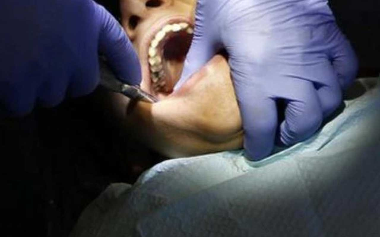 Çocuğun ağzında 526 diş bulundu tıp dünyasını şoke eden olay!