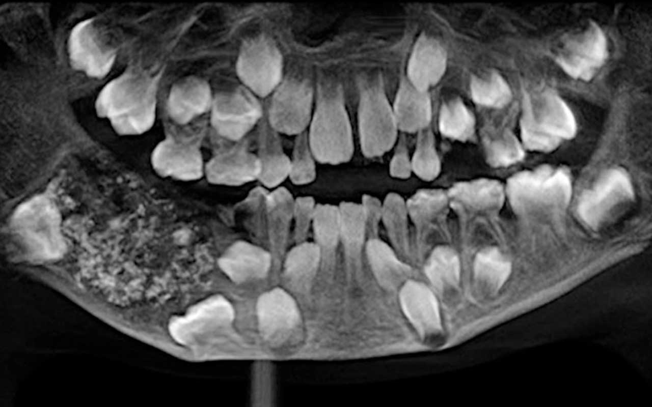 7 yaşındaki çocuğun ağzından 526 diş çıkarıldı