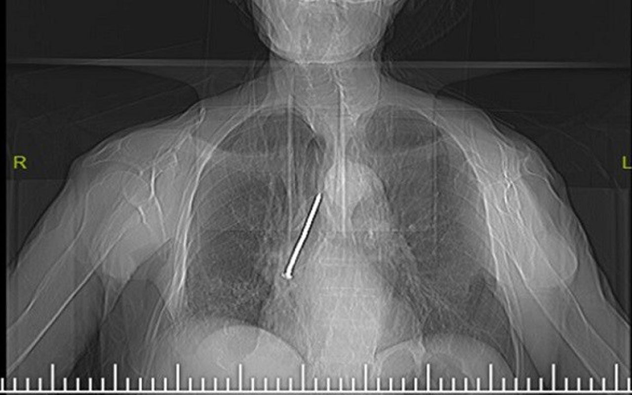 Soluk borusuna kaçan 10 santimlik çivi çıkarıldı