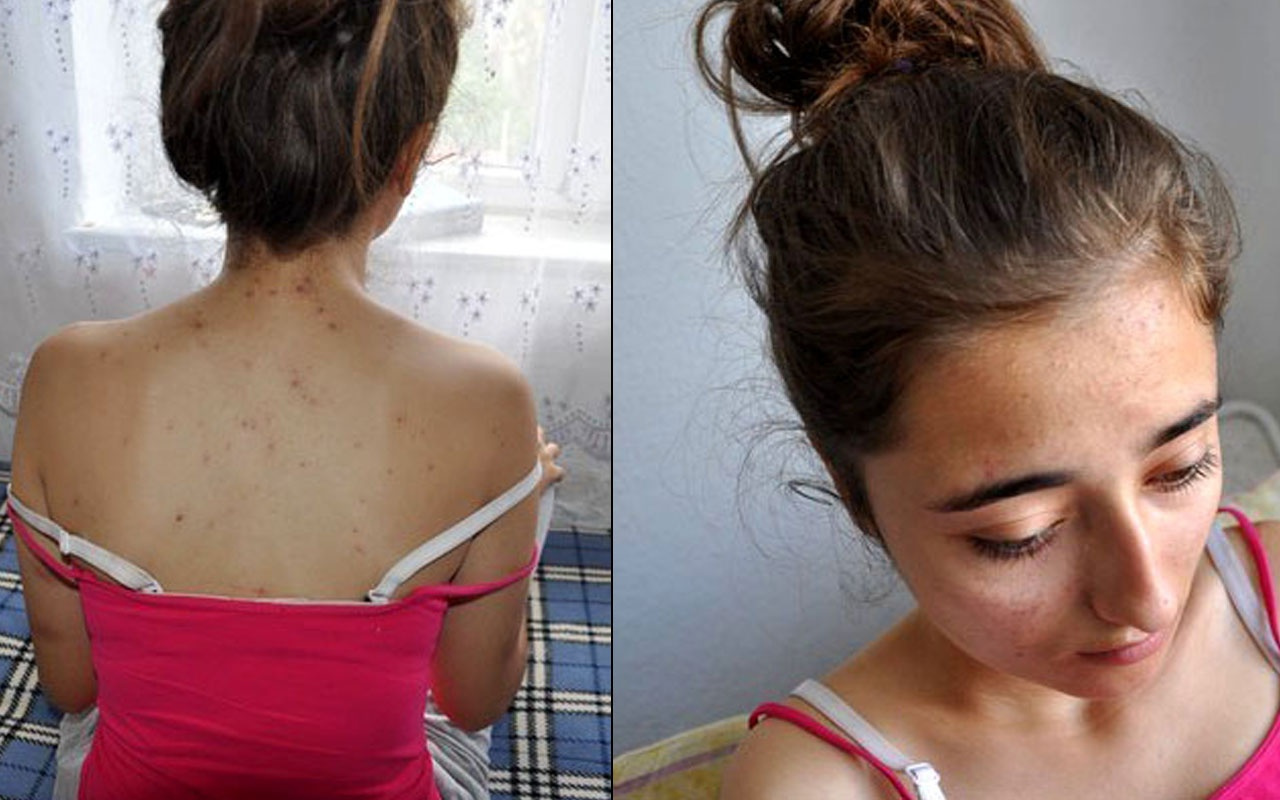 Çanakkale'de 17 yaşındaki Hilal Yavaş kız evine giderken arıların saldırısına uğradı!