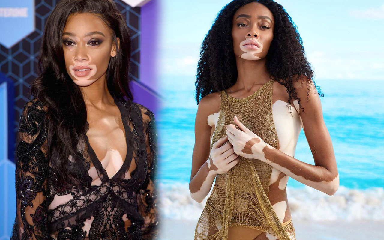 Vitiligo'lu model Winnie Harlow uçak pozu nedeniyle eleştirilere maruz kaldı