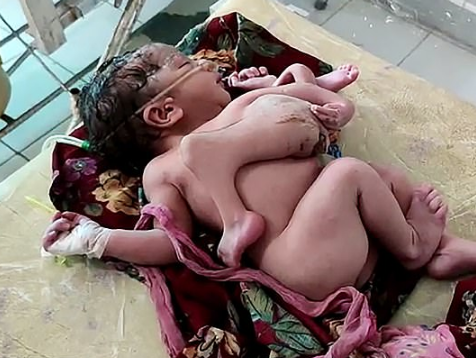 Hindistan'da bir ilk! Tıp dünyası şokta 4 bacaklı 3 kollu doğdu