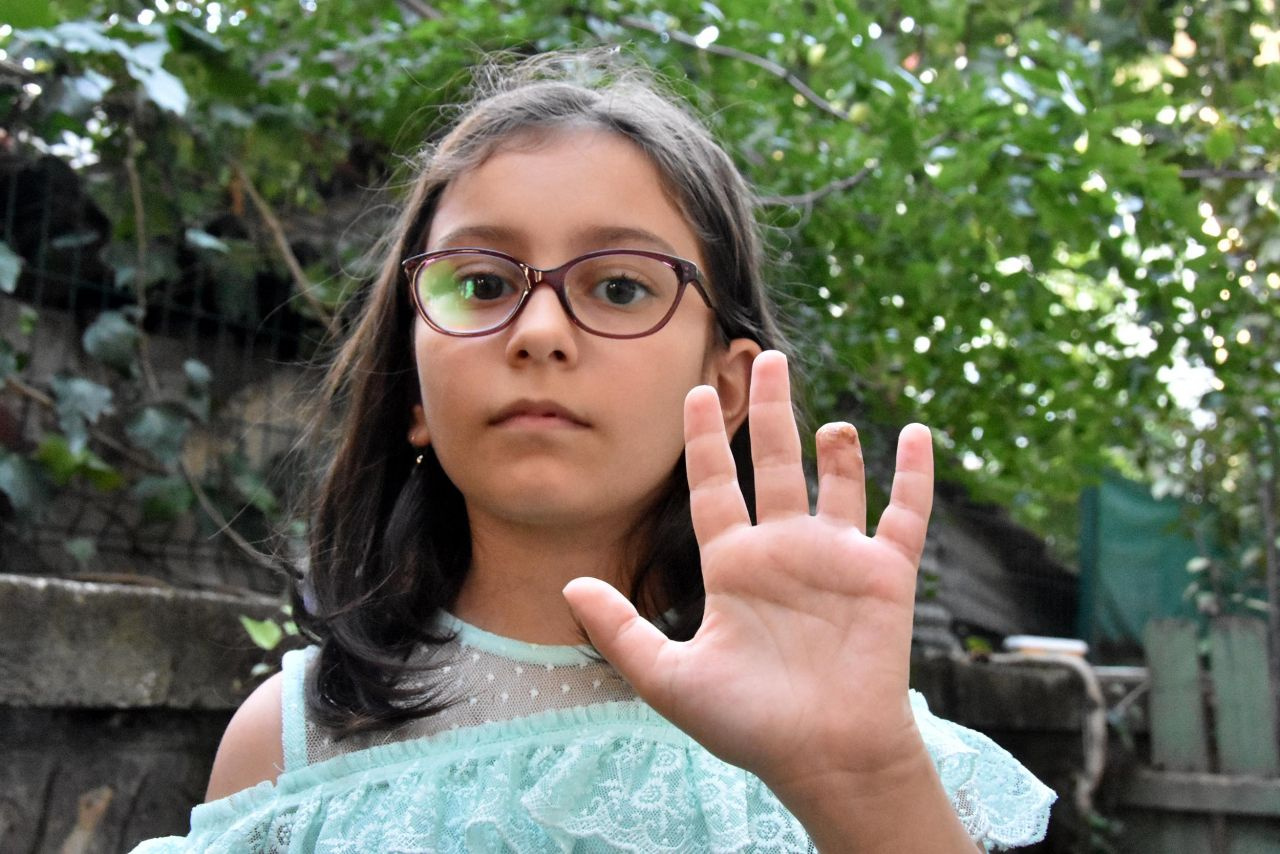 Mersin'de balon balığı 8 yaşındaki çocuğun parmağının yarısını kopardı