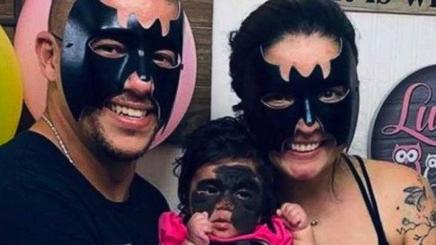 'Batman' maskesi ile doğdu iyileşmesi için on binlerce kişi seferber oldu