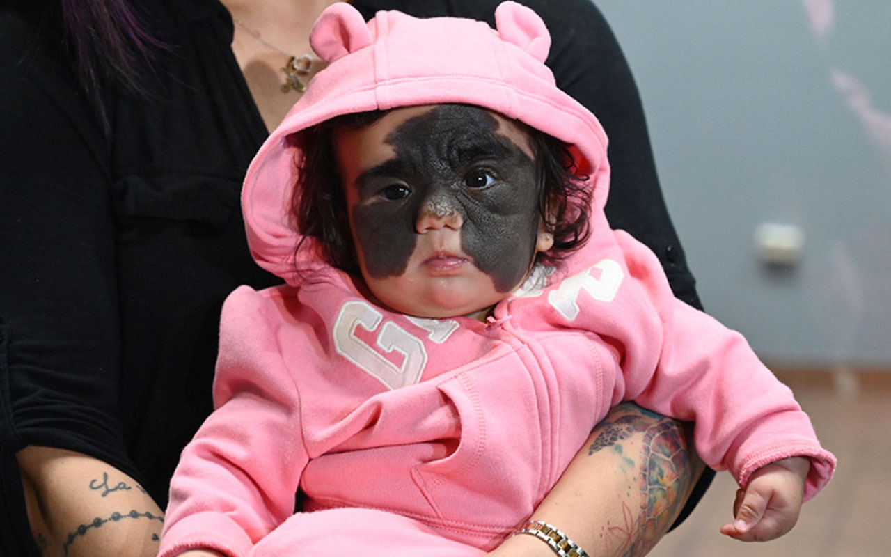 'Batman' maskesi ile doğdu iyileşmesi için on binlerce kişi seferber oldu
