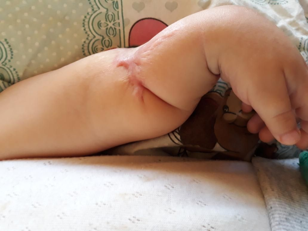 Bursa'da İsa bebeğin kolundaki yaranın sebebi bulunamıyor