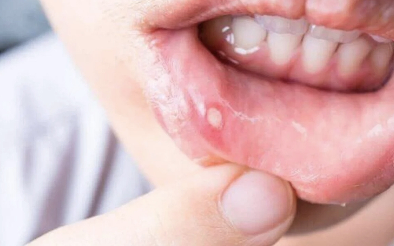Aft nasıl geçer evde ağız yarası aft tedavisi nasıl yapılır?