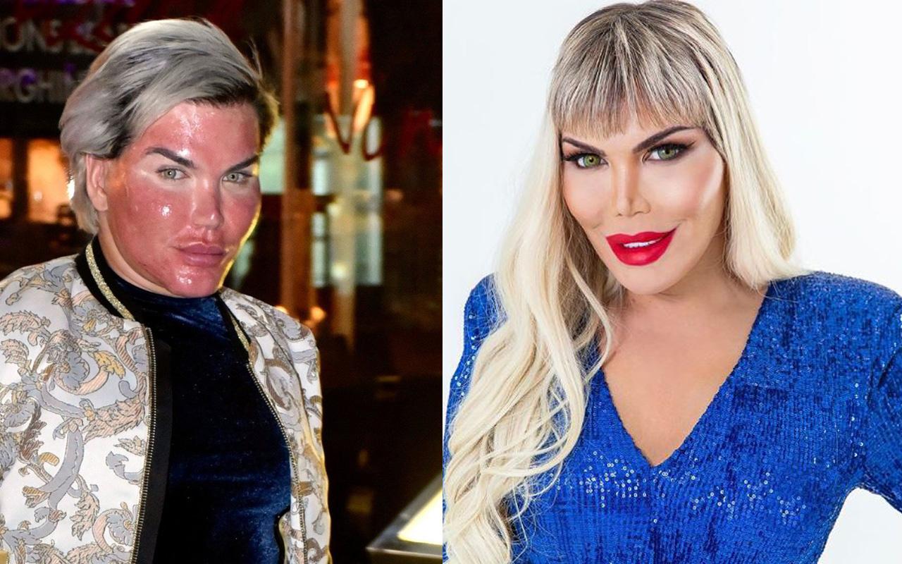 'Ken Bebek' Rodrigo Alves estetik sonrası halini takipçileriyle paylaştı!