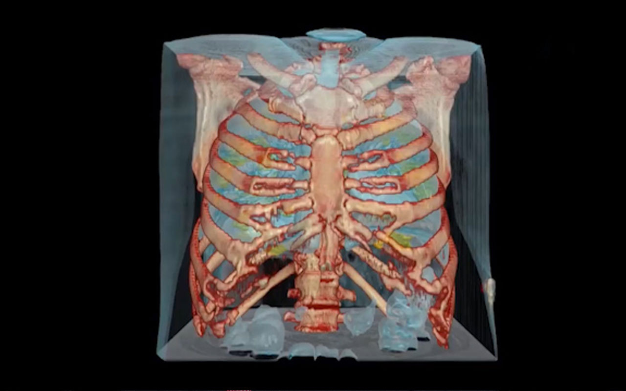 Koronavirüs bulunan akciğerin 3D görüntüsü yayımlandı