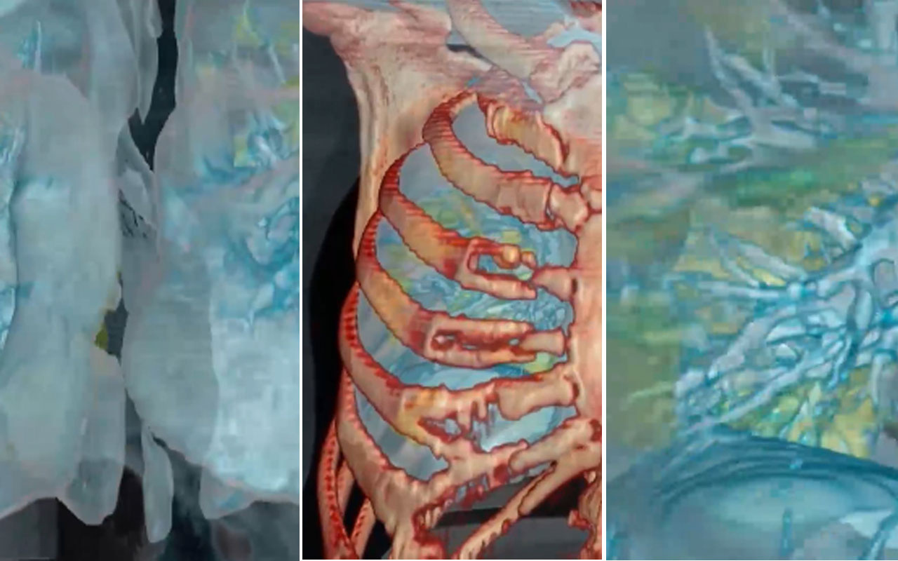 Koronavirüs bulunan akciğerin 3D görüntüsü korkuttu